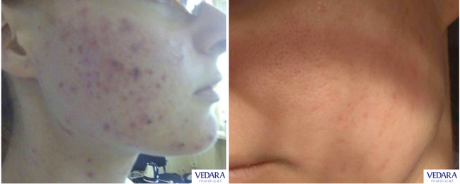 Zestaw Anti-Acne VEDARA MEDICAL 20 zabiegów 