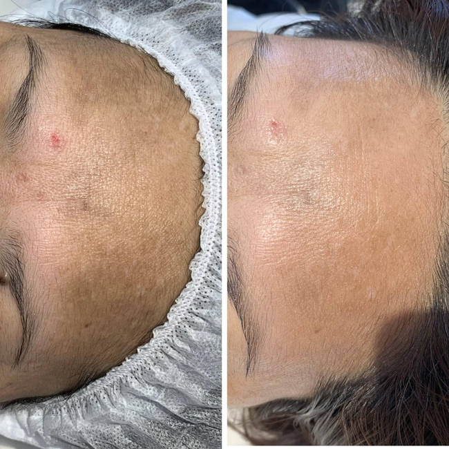 Zestaw Anti-Pigmentation VEDARA MEDICAL 20 zabiegów